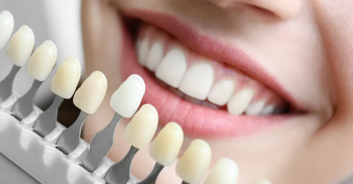 Understanding the Natural Color of Teeth: What’s Normal